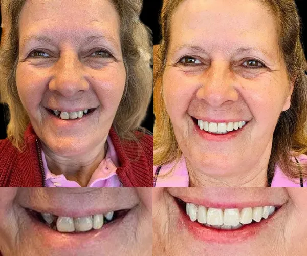 Rezultat transformare dentara
