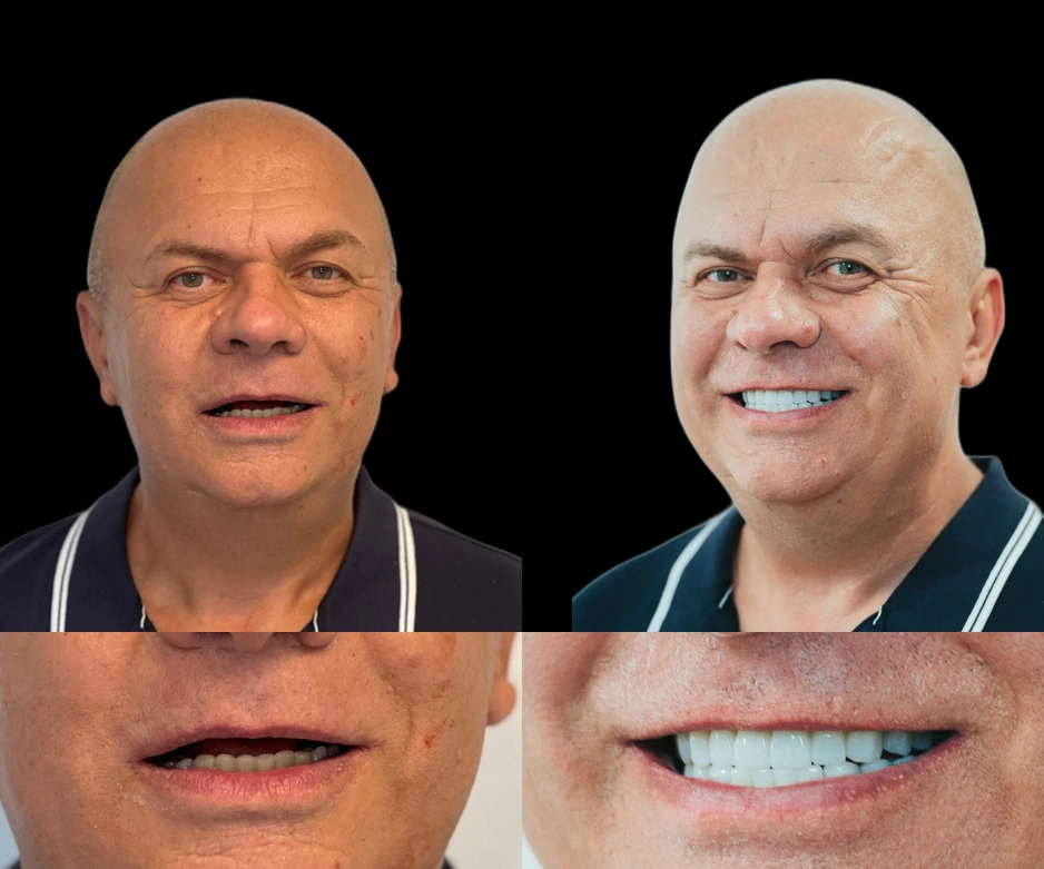 Rezultat transformare dentara