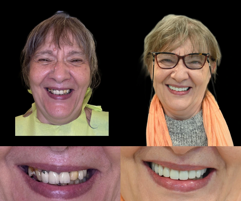 Rezultat transformare dentara