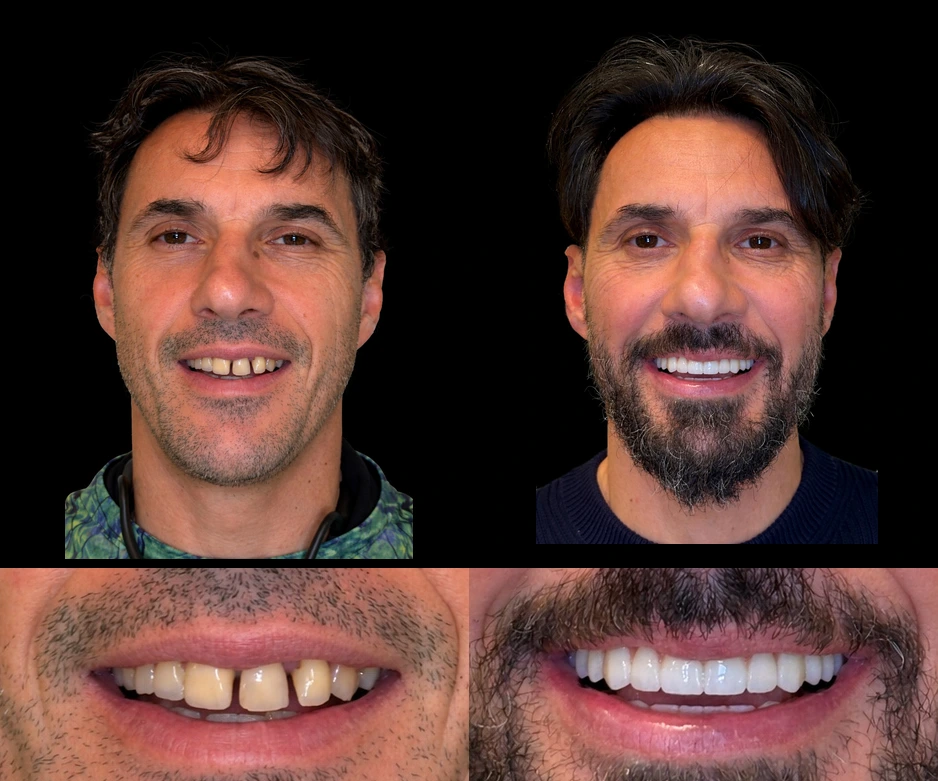 Rezultat transformare dentara